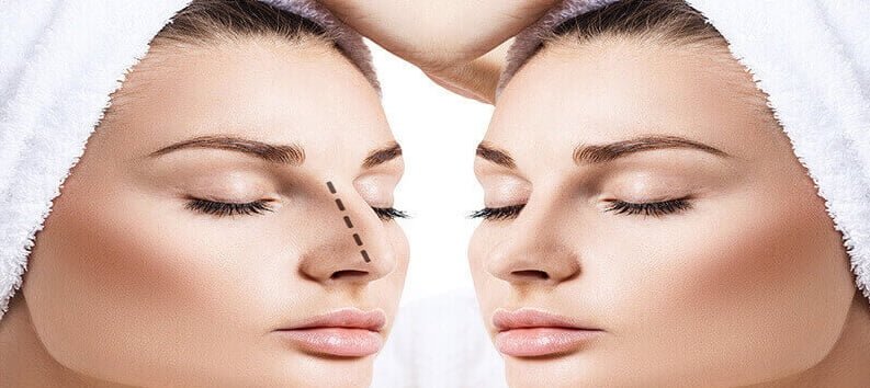 صفر تا صد جراحی بینی؛ عمل بینی و نکاتی در مورد آن
