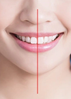 میدلاین دندان چیست؟ روش درمان و انواع میدلاین