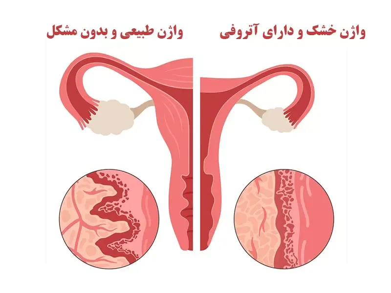 دلایل خشکی واژن؛ علائم، روش های تشخصی و درمان خشکی واژن