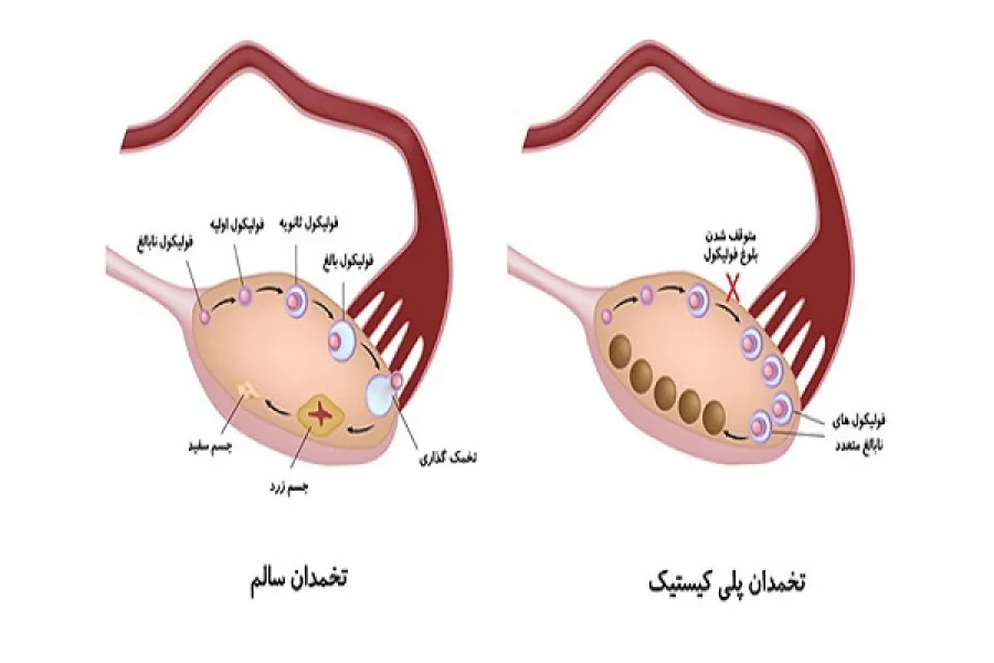 سندرم تخمدان پلی‌کیستیک؛ علائم، دلایل این بیماری و روش های درمان آن