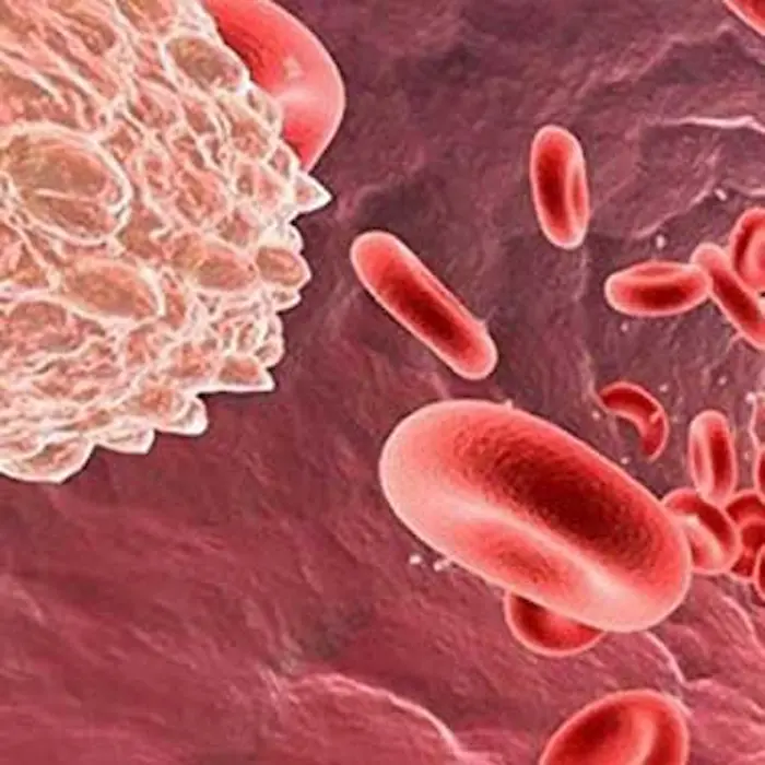 کم خونی داسی شکل کودک؛ علائم و روش های درمان این نوع کم خونی