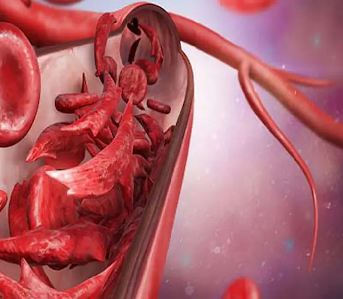 کم خونی داسی شکل کودک؛ علائم و روش های درمان این نوع کم خونی