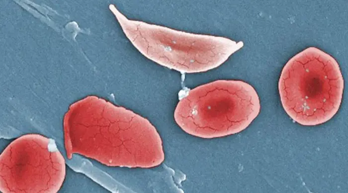 کم خونی داسی شکل کودک؛ علائم و روش های درمان این نوع کم خونی