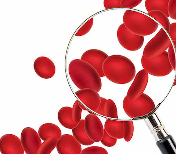 کم خونی داسی شکل کودک؛ علائم و روش های درمان این نوع کم خونی