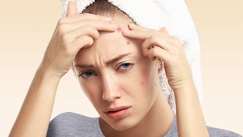 انواع جوش صورت و دلیل آنها؛ روش های پیشگیری جوش صورت در زنان و مردان