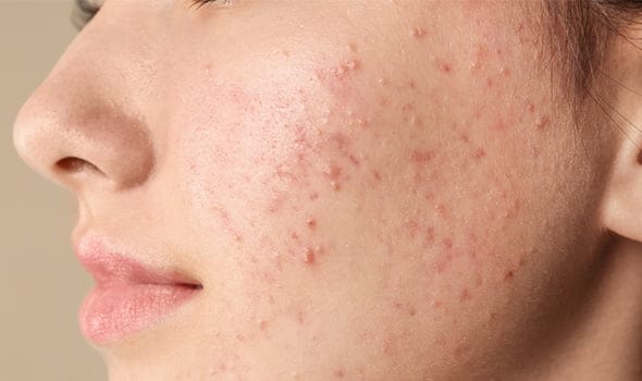 انواع جوش صورت و دلیل آنها؛ روش های پیشگیری جوش صورت در زنان و مردان