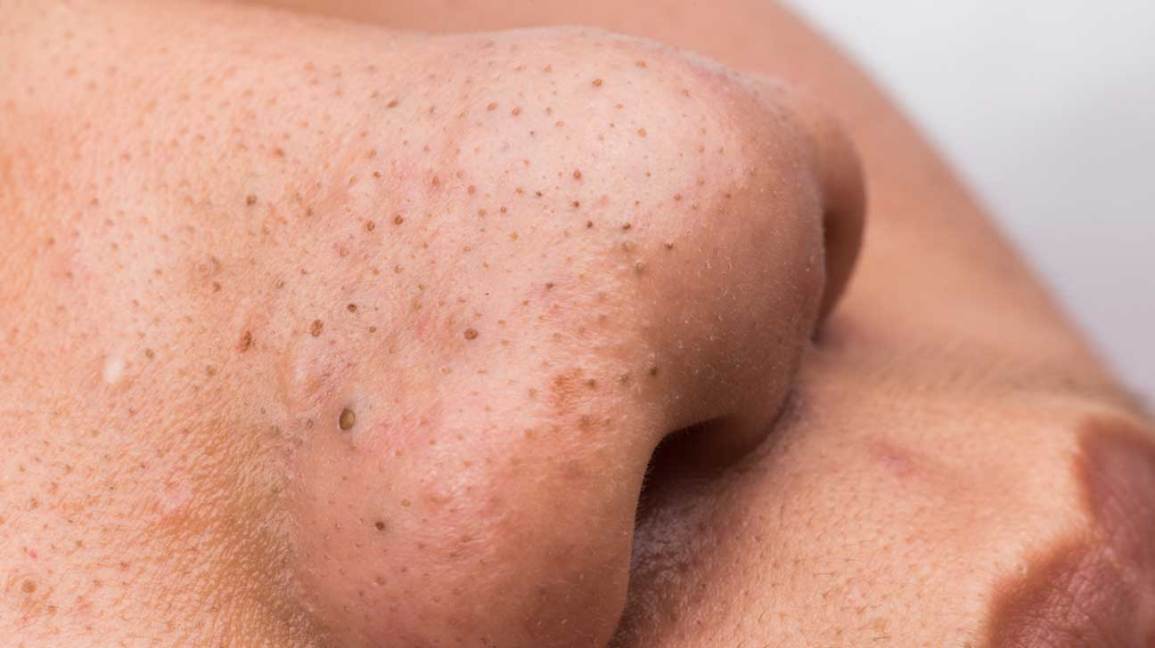 انواع جوش صورت و دلیل آنها؛ روش های پیشگیری جوش صورت در زنان و مردان