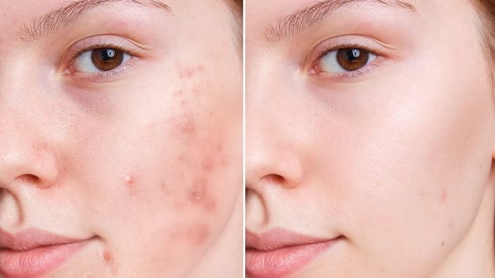 انواع جوش صورت و دلیل آنها؛ روش های پیشگیری جوش صورت در زنان و مردان