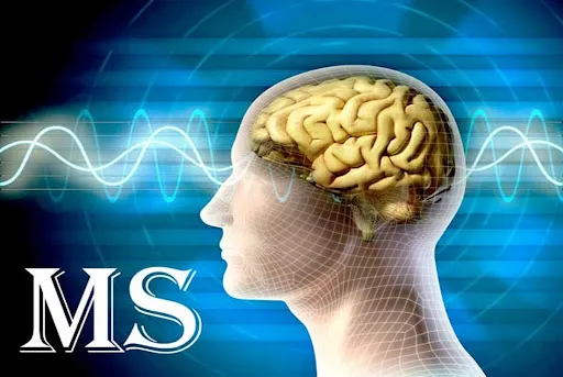 همه چیز درباره بیماری ام اس؛ علائم و نحوه درمان و راهکارهای کنترل MS