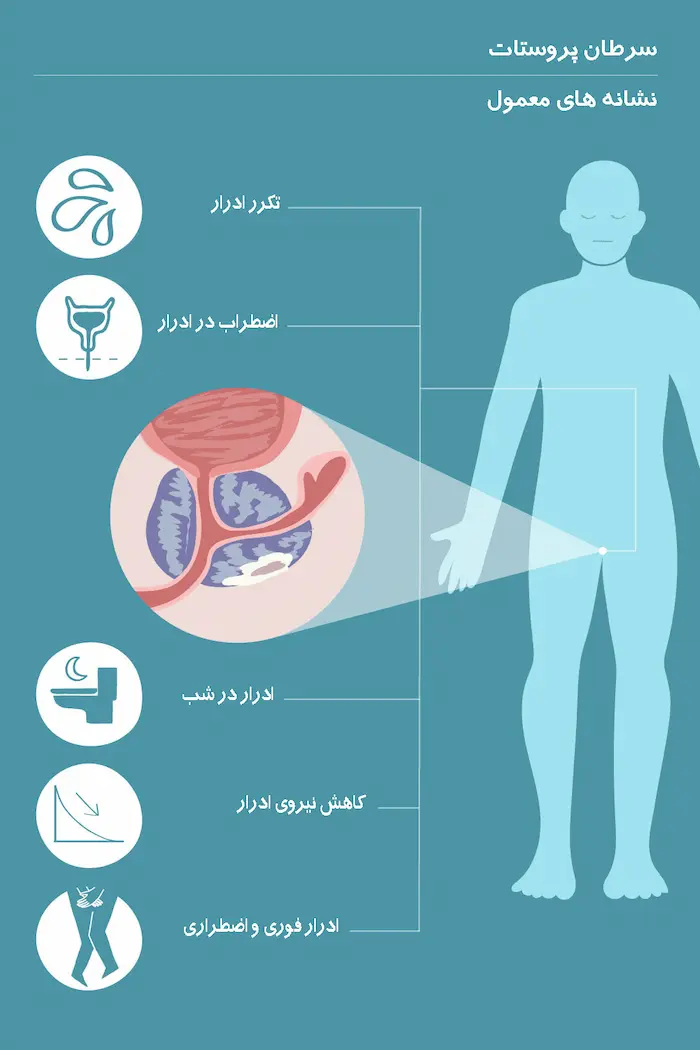 دلیل ابتلا به سرطان پروستات؛ انواع این بیماری و روش های درمان آن