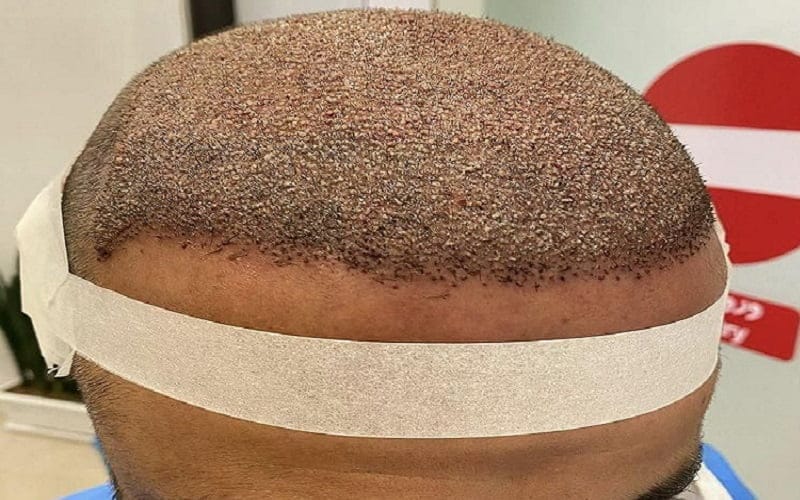 چرا هزینه کاشت مو در مناطق مختلف متفاوت است؟