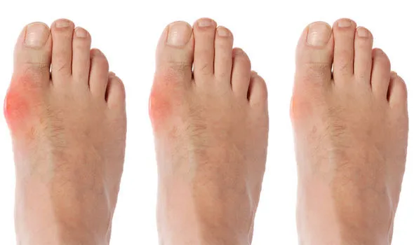 همه چیز درباره بیماری نقرس یا Gout (دلیل ایجاد، پیشگیری و درمان)