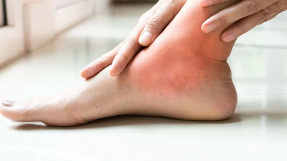 همه چیز درباره بیماری نقرس یا Gout (دلیل ایجاد، پیشگیری و درمان)