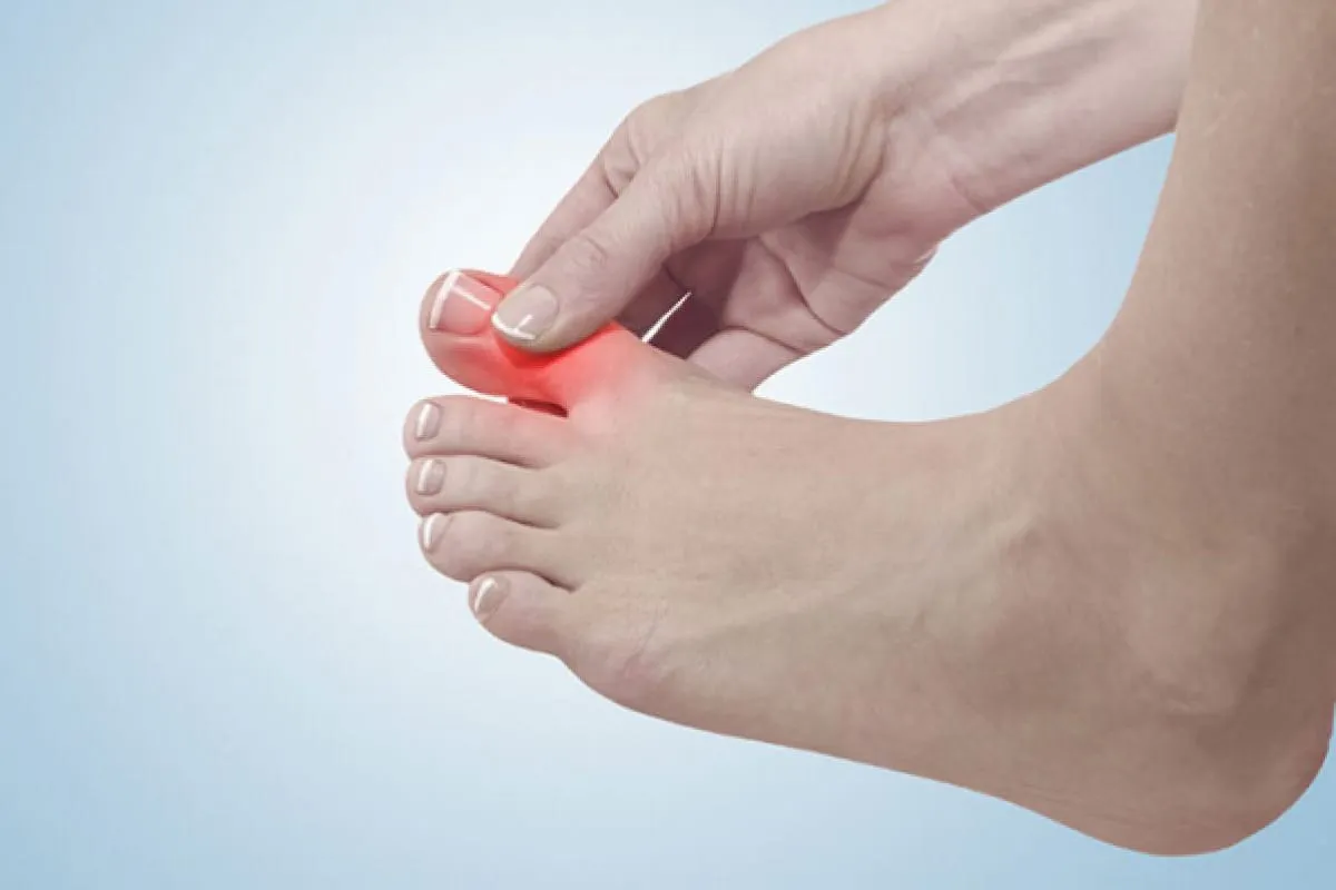 همه چیز درباره بیماری نقرس یا Gout (دلیل ایجاد، پیشگیری و درمان)