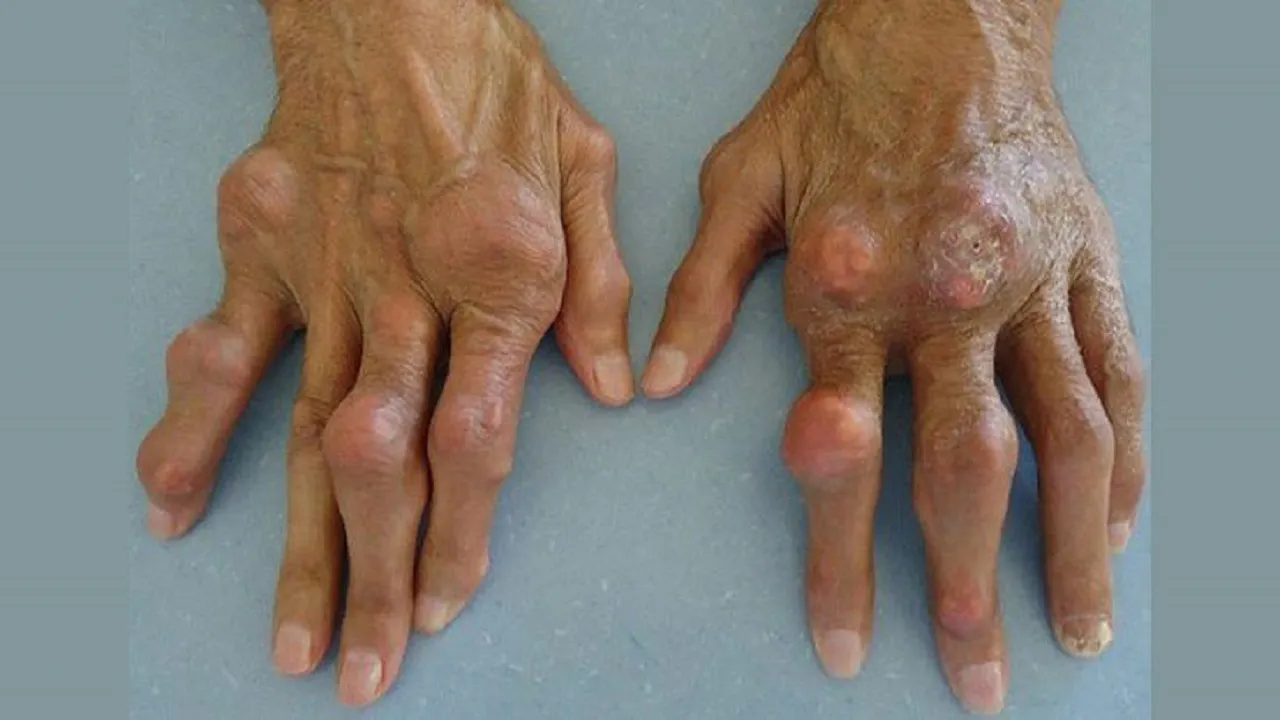 همه چیز درباره بیماری نقرس یا Gout (دلیل ایجاد، پیشگیری و درمان)