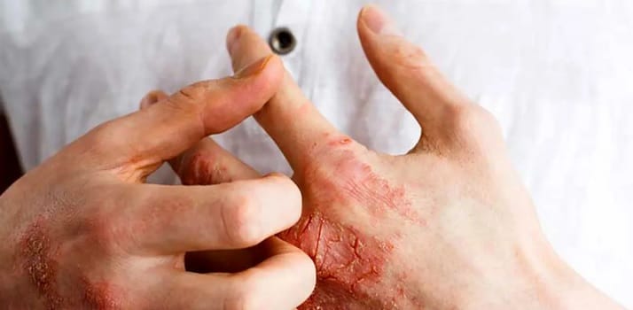 بیماری سلیاک چیست؟ همه چیز در مورد عدم تحمل گلوتن