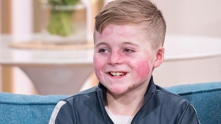 همه چیز در مورد بیماری پروانه ای؛ علائم، انواع بیماری و راهکارهای درمانی