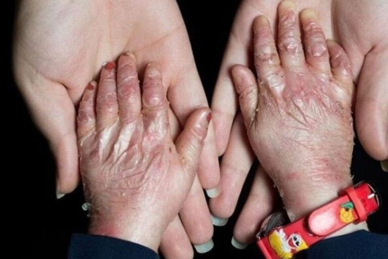 همه چیز در مورد بیماری پروانه ای؛ علائم، انواع بیماری و راهکارهای درمانی