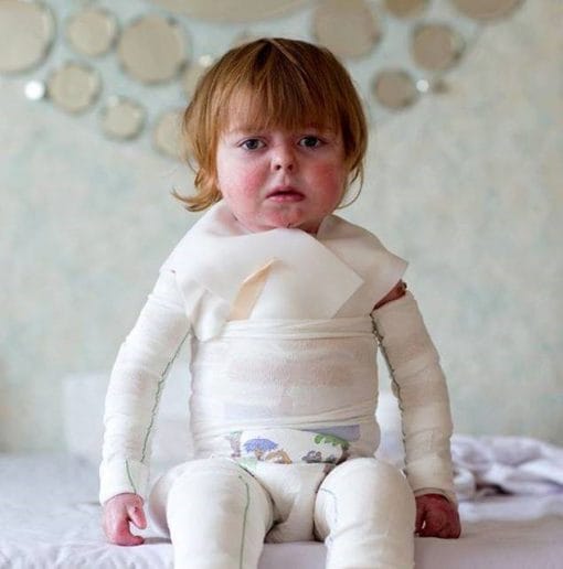 همه چیز در مورد بیماری پروانه ای؛ علائم، انواع بیماری و راهکارهای درمانی