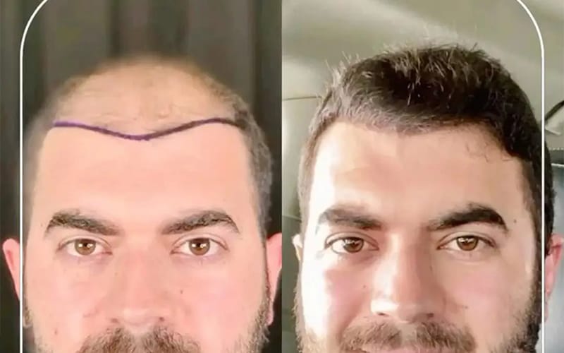 راهکاری دائمی برای مقابله با ریزش مو