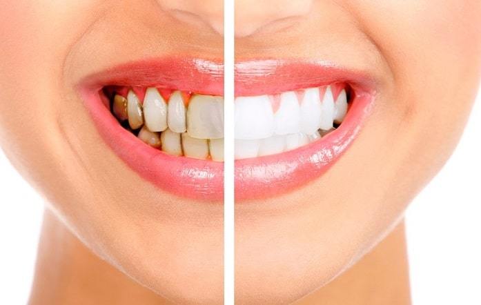 روش های طبیعی سفید کردن دندان ها و دلایلی که باعث زردی رنگ دندان می شود