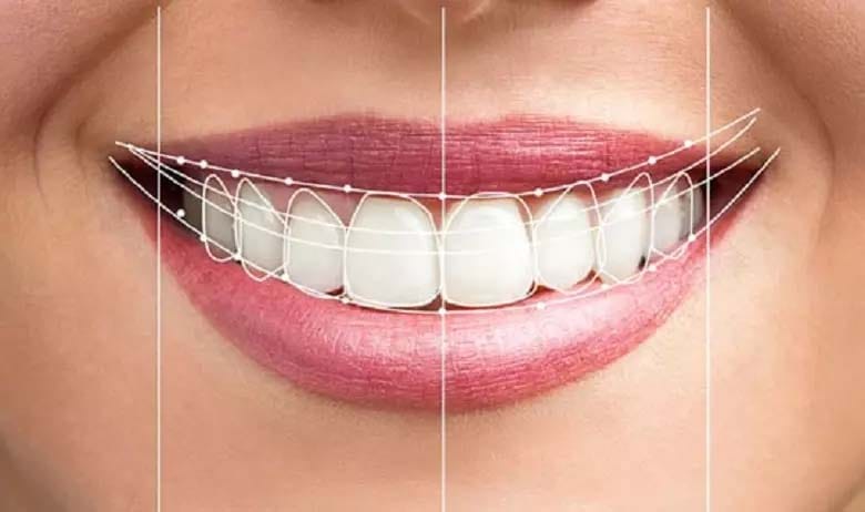 تفاوت لمینت و کامپوزیت؛ مقایسه ویژگی ها و نحوه انجام