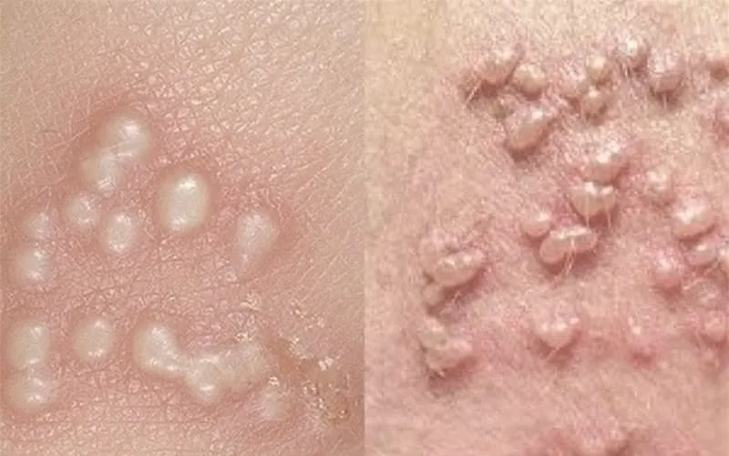 زگیل تناسلی و همه چیز در مورد این زائده های ناحیه تناسلی و درمان آن