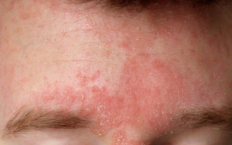 اگزما چیست و چطور به آن دچار می شویم؟ نشانه ها و روش درمان