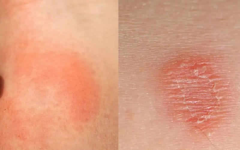 اگزما چیست و چطور به آن دچار می شویم؟ نشانه ها و روش درمان