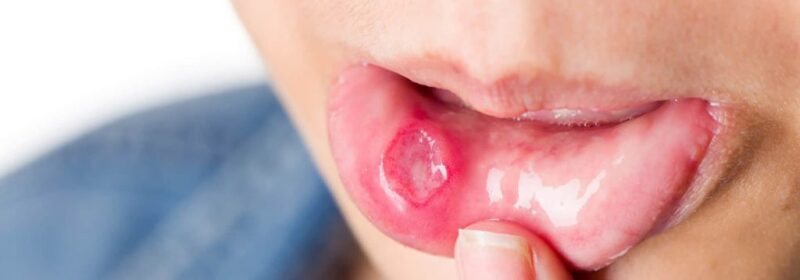 آفت دهان چیست؟ تمام روش های درمان این بیماری دهانی آفت دهان چیست؟ تمام روش های درمان این بیماری دهانی