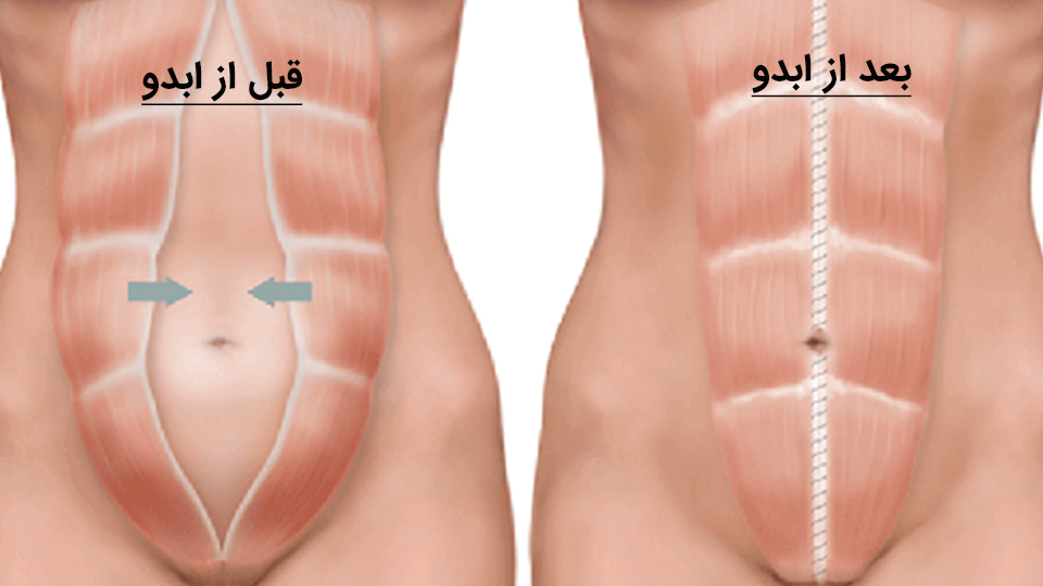 ابدومینوپلاستی جراحی زیبایی شکم | فواید و عوارض این روش