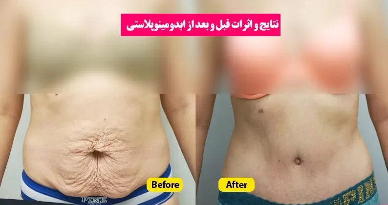 ابدومینوپلاستی جراحی زیبایی شکم | فواید و عوارض این روش