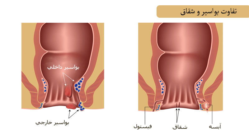 اطلاعات درباره شقاق و فیستول مقعدی (روش های درمان و پیشگیری)