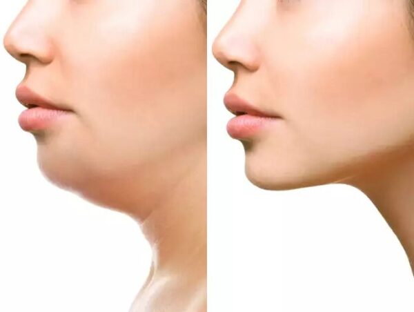 اطلاعات درباره لیفت غبغب و مزایای و معایبی که این روش زیبایی دارد