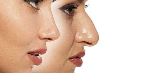 اطلاعات عمومی درباره عمل جراحی زیبایی بینی (عوارض، نحوه عمل و هزینه ها)