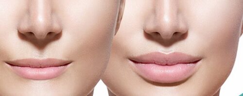 اطلاعات کامل درباره تزریق ژل لب، مزایای آن، مراقبت ها و روش های انجام