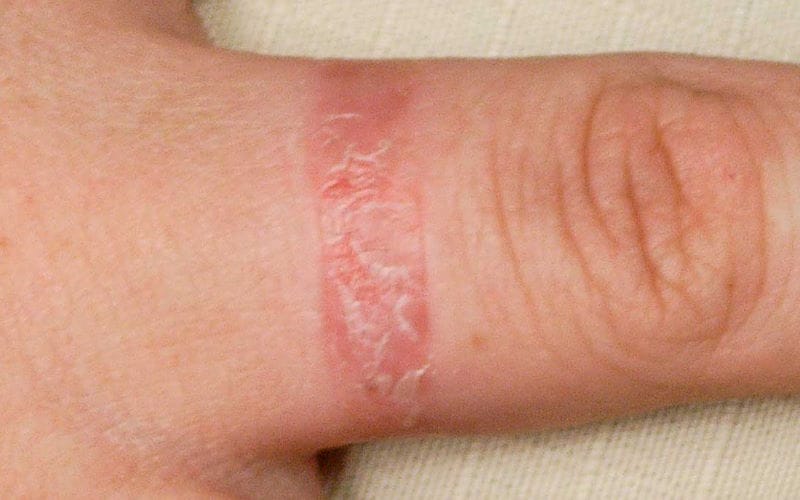 اگزما چیست و چطور به آن دچار می شویم؟ نشانه ها و روش درمان