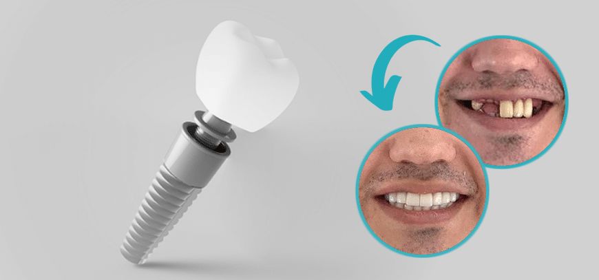 بریج بهتر است یا ایمپلنت ؟
