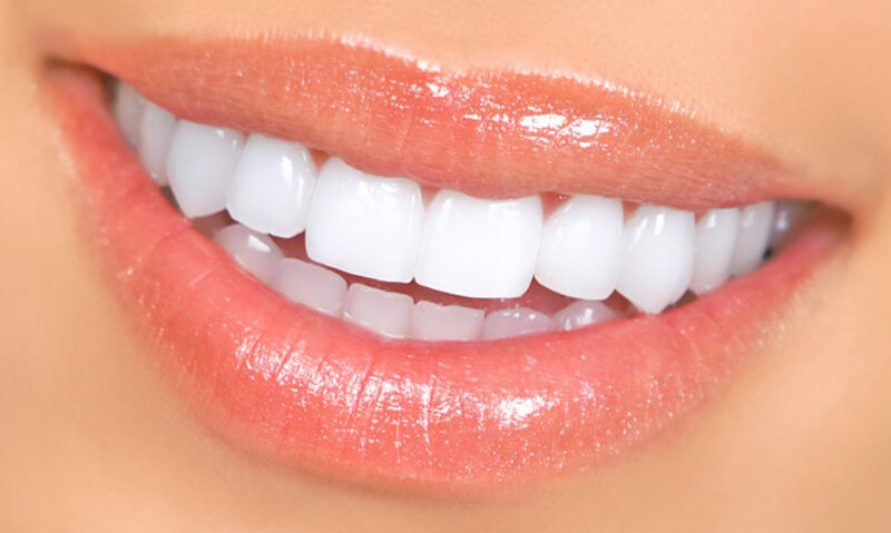 بلیچینگ دندان (سفید کردن دندان ها) و مزایا و معایبی که دارد