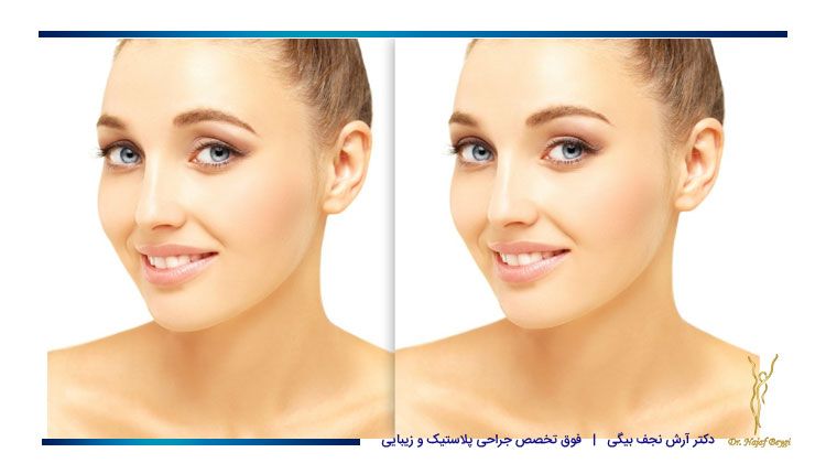 بهترین روش های لیفت ابرو