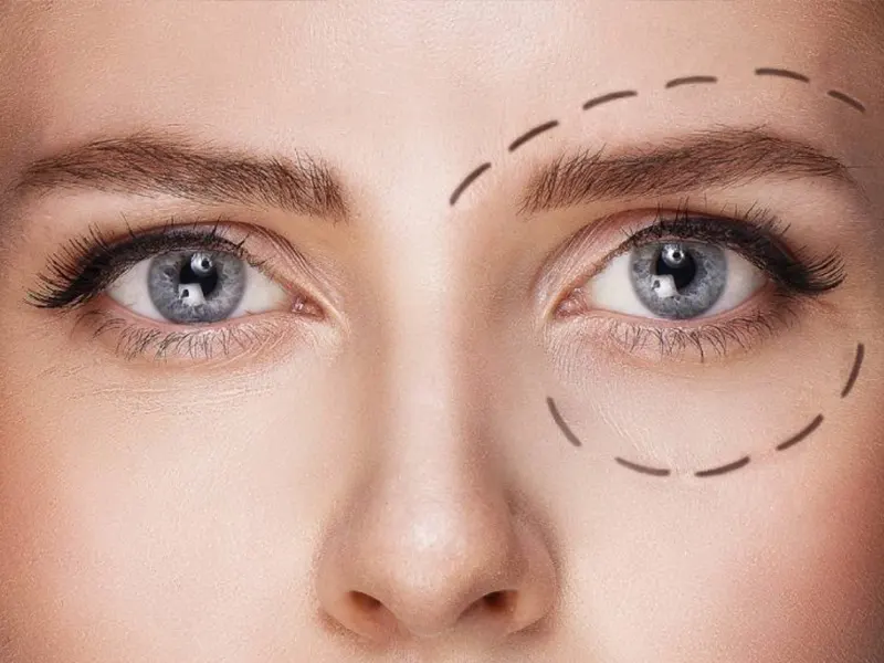 تزریق فیلر زیر چشم چیست؟ هدف، مراحل، شرایط و مزایای انجام این روش