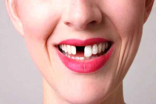 تعبیر خواب افتادن دندان جلو زن بدون خونریزی + معنی افتادن دندان جلو زن در خواب چیست