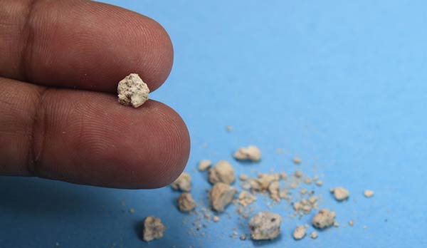 تعبیر خواب خارج شدن سنگ از بدن + معنی خارج شدن سنگ از بدن در خواب چیست