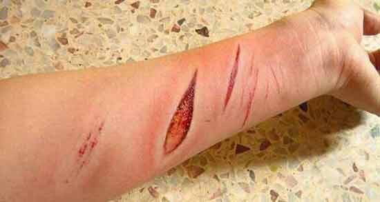 تعبیر خواب زخم شدن دست دیگران معنی زخم شدن دست دیگران در خواب های ما چیست تعبیر خواب زخم شدن دست دیگران معنی زخم شدن دست دیگران در خواب های ما چیست