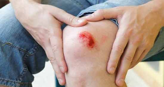 تعبیر خواب زخم چرکی معنی زخم چرکی در خواب های ما چیست تعبیر خواب زخم چرکی معنی زخم چرکی در خواب های ما چیست