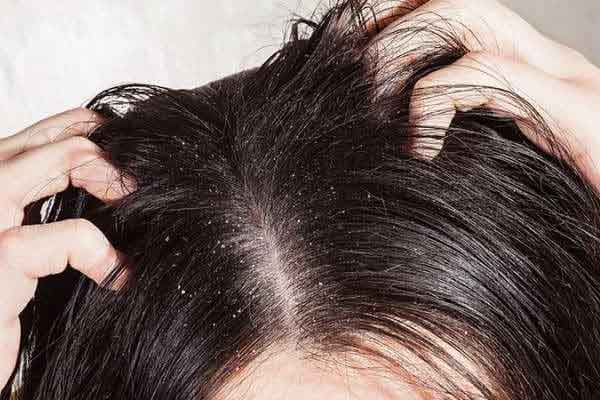 تعبیر خواب شپش نی نی سایت + معنی شپش در خواب های ما چیست