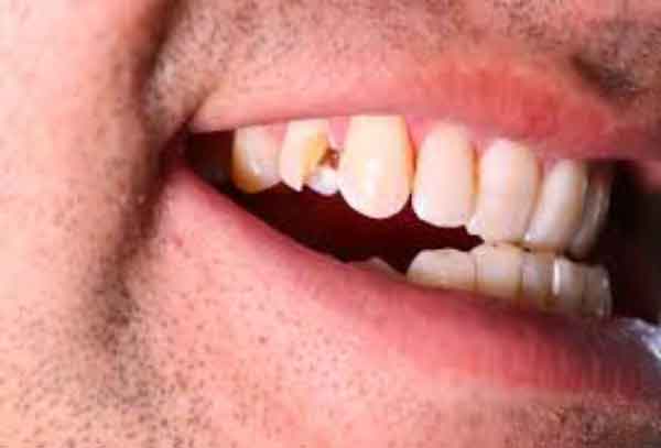 تعبیر خواب شکستن دندان آسیاب ابن سیرین و خراب شدن در خواب دختر مجرد
