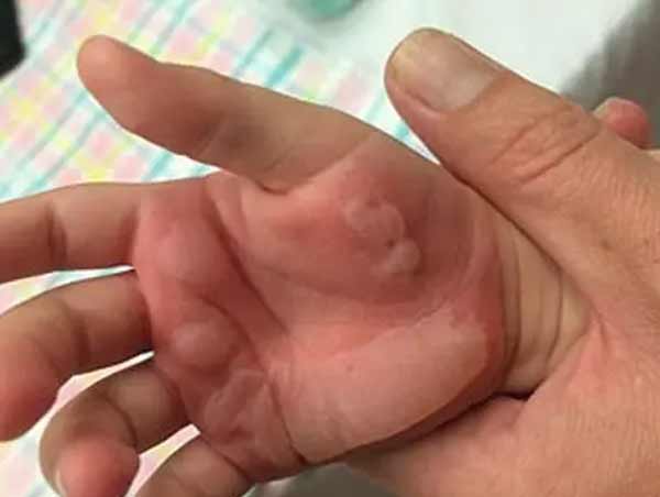 تعبیر خواب مار گزیدگی دست راست + معنی مار گزیدگی دست راست در خواب چیست