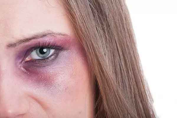 تعبیر خواب کبودی زیر چشم + معنی کبودی زیر چشم در خواب های ما چیست