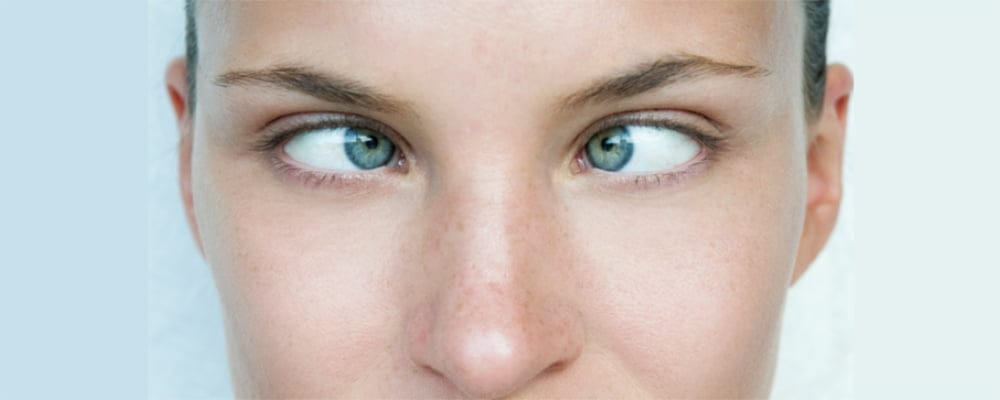 جراحی انحراف چشم؛ علائم، دلایل و روش های پیشگیری از مشکل انحراف چشم